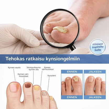 KynsiHoito – Tehokas hoito kynsisientä vastaan
